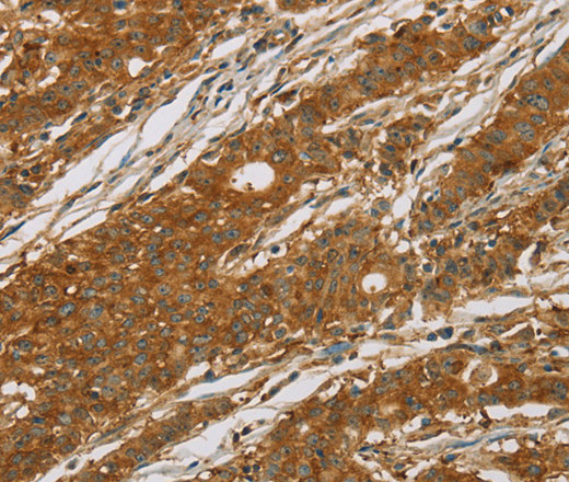 Immunohistochemistry of paraffin-embedded Human gasrtic cancer tissue using CYP27A1 Polyclonal Antibody at dilution 1:50