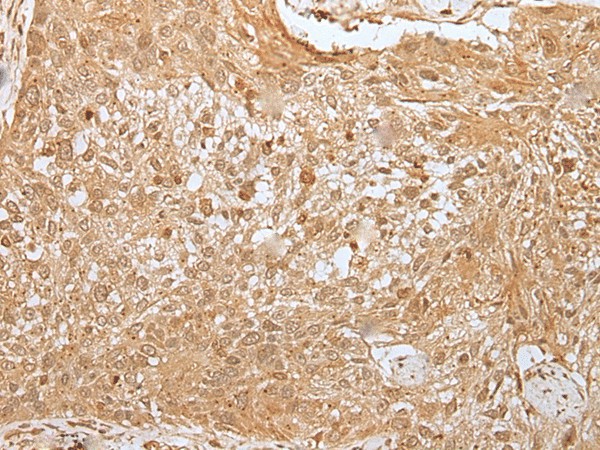 Immunohistochemistry of paraffin-embedded Human lung cancer tissue  using MORF4L1 Polyclonal Antibody at dilution of 1:30(?200)