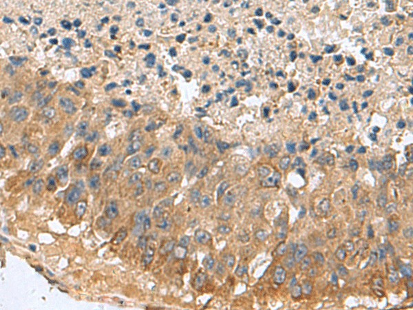 Immunohistochemistry of paraffin-embedded Human liver cancer tissue  using MARCKSL1 Polyclonal Antibody at dilution of 1:70(?200)