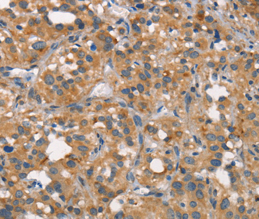 Immunohistochemistry of paraffin-embedded Human thyroid cancer tissue using CEACAM6 Polyclonal Antibody at dilution 1:50