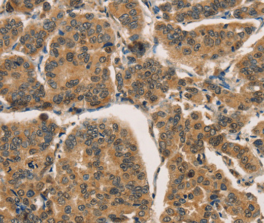 Immunohistochemistry of paraffin-embedded Human breast cancer tissue using CTNNBIP1 Polyclonal Antibody at dilution 1:30