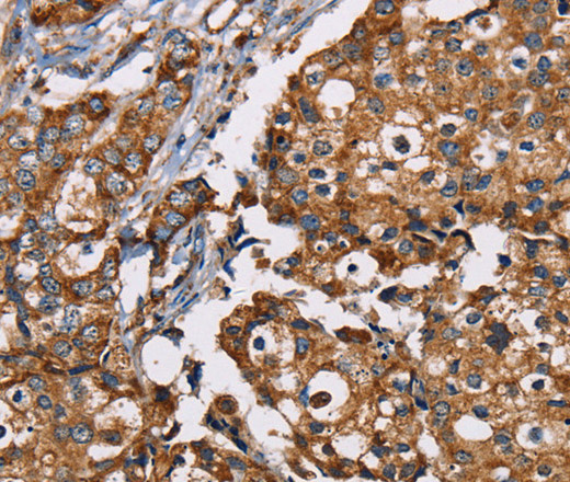 Immunohistochemistry of paraffin-embedded Human breast cancer using NDUFS1 Polyclonal Antibody at dilution of 1:35