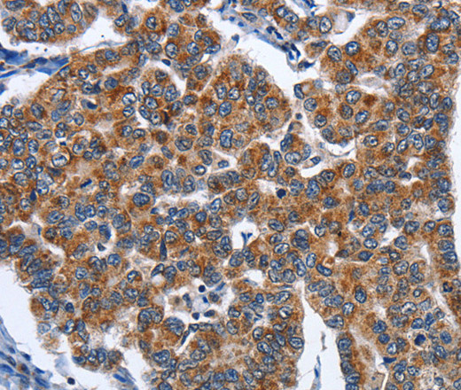 Immunohistochemistry of paraffin-embedded Human breast cancer tissue using CADM3 Polyclonal Antibody at dilution 1:40