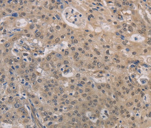 Immunohistochemistry of paraffin-embedded Human gastric cancer using DPYSL3 Polyclonal Antibody at dilution of 1:30