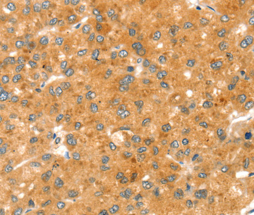 Immunohistochemistry of paraffin-embedded Human liver cancer using RAB27A Polyclonal Antibody at dilution of 1:30