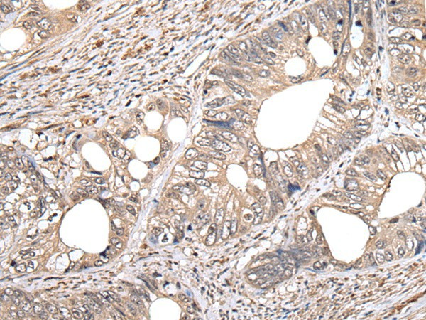 Immunohistochemistry of paraffin-embedded Human colorectal cancer tissue  using GCNT2 Polyclonal Antibody at dilution of 1:60(?200)