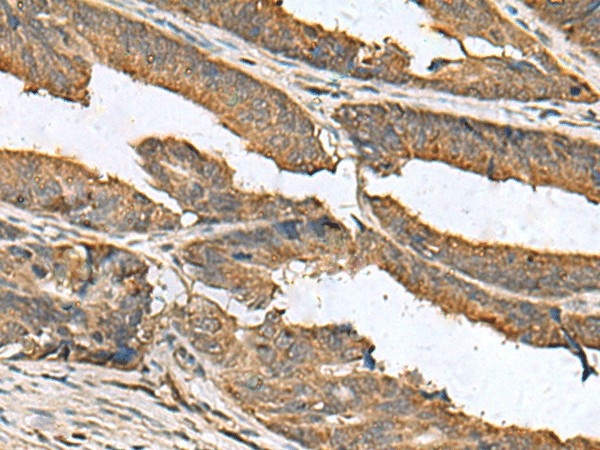 Immunohistochemistry of paraffin-embedded Human colorectal cancer tissue  using EIF1AX Polyclonal Antibody at dilution of 1:105(?200)