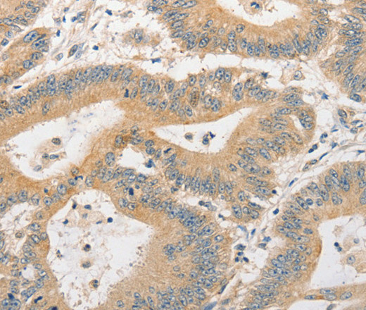 Immunohistochemistry of paraffin-embedded Human colon cancer tissue using BCL2L14 Polyclonal Antibody at dilution 1:40