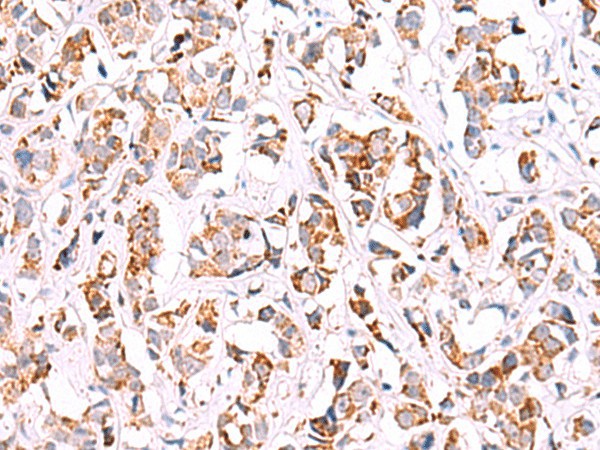 Immunohistochemistry of paraffin-embedded Human breast cancer tissue  using SIGLEC6 Polyclonal Antibody at dilution of 1:50(?200)