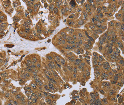 Immunohistochemistry of paraffin-embedded Human ovarian cancer tissue using IKBIP Polyclonal Antibody at dilution 1:40