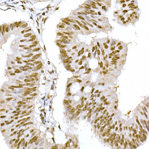 Immunohistochemistry of paraffin-embedded human colon carcinoma using GTF2F1 Polyclonal Antibody at dilution of 1:150 (40x lens).Perform high pressure antigen retrieval with 10 mM citrate buffer pH 6.0 before commencing with IHC staining protocol.