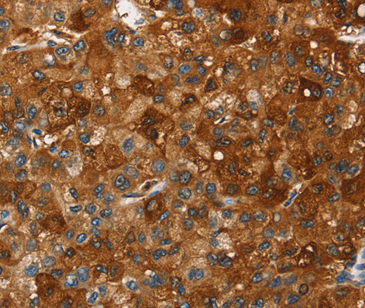 Immunohistochemistry of paraffin-embedded Human liver cancer using PAK2 Polyclonal Antibody at dilution of 1:40