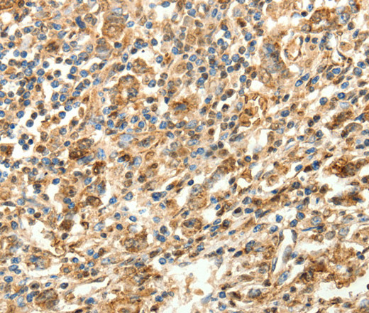 Immunohistochemistry of paraffin-embedded Human gastric cancer using SLC25A11 Polyclonal Antibody at dilution of 1:30