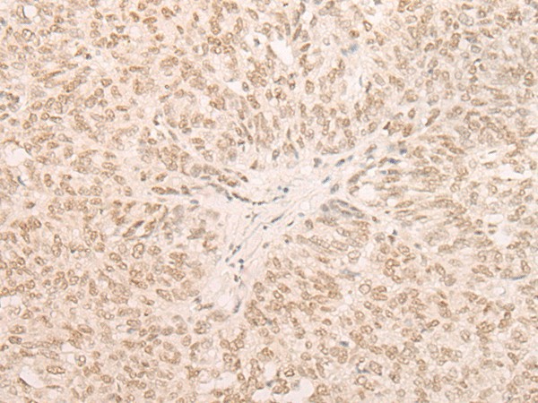 Immunohistochemistry of paraffin-embedded Human ovarian cancer tissue  using EIF4A3 Polyclonal Antibody at dilution of 1:35(?200)