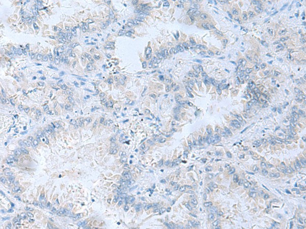 Immunohistochemistry of paraffin-embedded Human lung cancer tissue  using ATP6V1C1 Polyclonal Antibody at dilution of 1:100(?200)