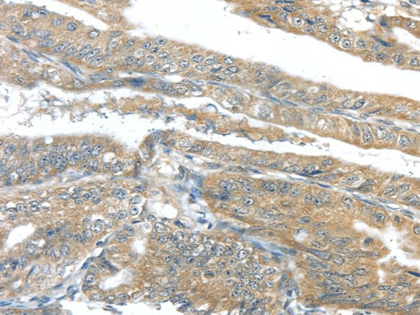 Immunohistochemistry of paraffin-embedded Human esophagus cancer tissue using AKT2 Polyclonal Antibody at dilution 1:40