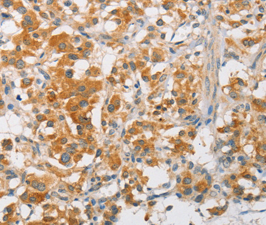 Immunohistochemistry of paraffin-embedded Human thyroid cancer using ARMCX3 Polyclonal Antibody at dilution of 1:40