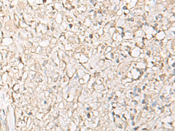 Immunohistochemistry of paraffin-embedded Human ovarian cancer tissue  using IGHA1 Polyclonal Antibody at dilution of 1:65(?200)