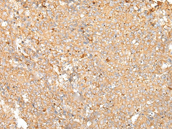 Immunohistochemistry of paraffin-embedded Human cervical cancer tissue  using PRDX4 Polyclonal Antibody at dilution of 1:25(?200)