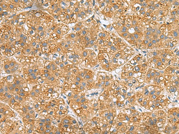 Immunohistochemistry of paraffin-embedded Human liver cancer tissue  using PPM1M Polyclonal Antibody at dilution of 1:50(?200)