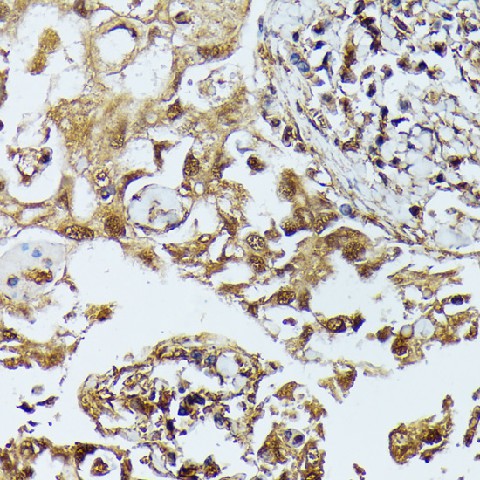 Immunohistochemistry of paraffin-embedded Human lung cancer using DAPK3 Polyclonal Antibody at dilution of 1:100 (40x lens).