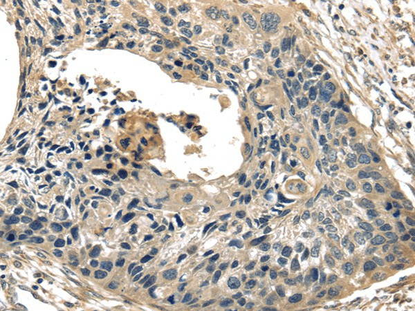 Immunohistochemistry of paraffin-embedded Human esophagus cancer tissue using TXNIP Polyclonal Antibody at dilution 1:40