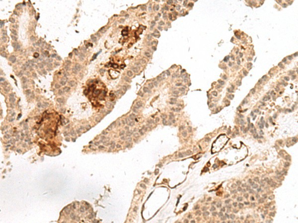 Immunohistochemistry of paraffin-embedded Human thyroid cancer tissue  using GRASP Polyclonal Antibody at dilution of 1:60(?200)