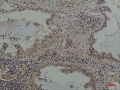 Immunohistochemistry of paraffin-embedded Human lung carcinoma tissue with Phosphoserine Monoclonal Antibody at dilution of 1:200