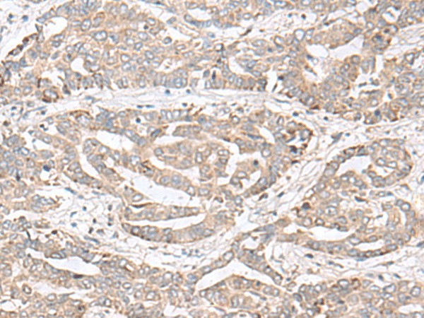 Immunohistochemistry of paraffin-embedded Human liver cancer tissue  using CHST4 Polyclonal Antibody at dilution of 1:35(?200)