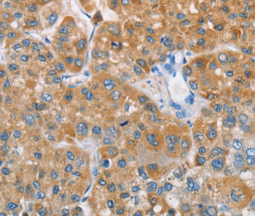 Immunohistochemistry of paraffin-embedded Human liver cancer tissue using BDH1 Polyclonal Antibody at dilution 1:60