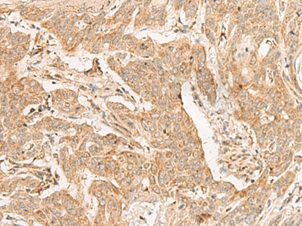 Immunohistochemistry of paraffin-embedded Human esophagus cancer tissue  using ADGRF1 Polyclonal Antibody at dilution of 1:25(?200)