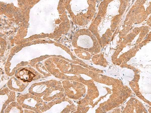 Immunohistochemistry of paraffin-embedded Human thyroid cancer tissue  using ETV3 Polyclonal Antibody at dilution of 1:25(?200)