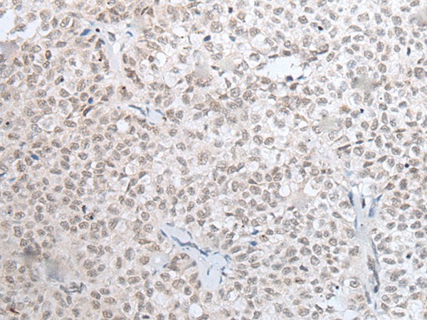 Immunohistochemistry of paraffin-embedded Human ovarian cancer tissue  using HOXC11 Polyclonal Antibody at dilution of 1:25(?200)