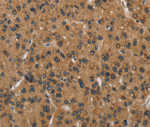 Immunohistochemistry of paraffin-embedded Human liver cancer using HSP40-4 Polyclonal Antibody at dilution of 1:30