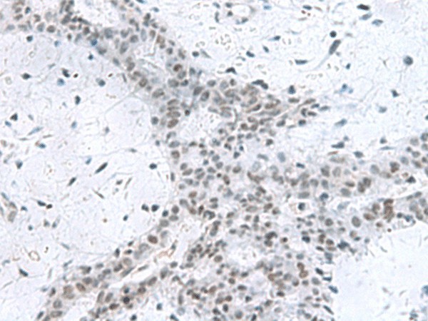 Immunohistochemistry of paraffin-embedded Human breast cancer tissue  using PCLAF Polyclonal Antibody at dilution of 1:80(?200)