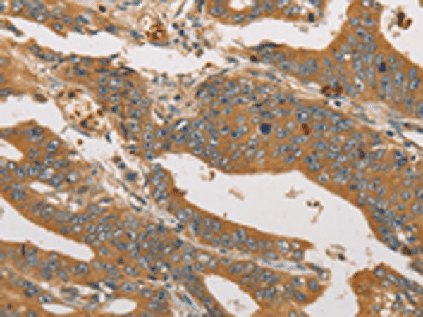 Immunohistochemistry of paraffin-embedded Human gastric cancer tissue  using XPR1 Polyclonal Antibody at dilution of 1:45(?200)