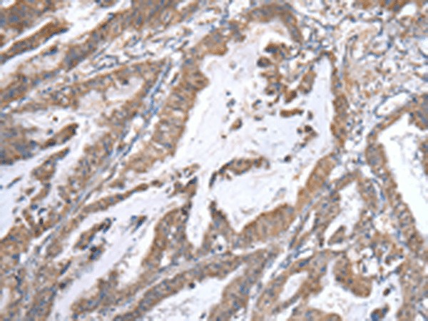 Immunohistochemistry of paraffin-embedded Human esophagus cancer tissue  using WWP1 Polyclonal Antibody at dilution of 1:40(?200)