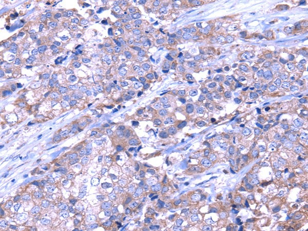 Immunohistochemistry of paraffin-embedded Human breast cancer tissue using SRPK1 Polyclonal Antibody at dilution 1:35