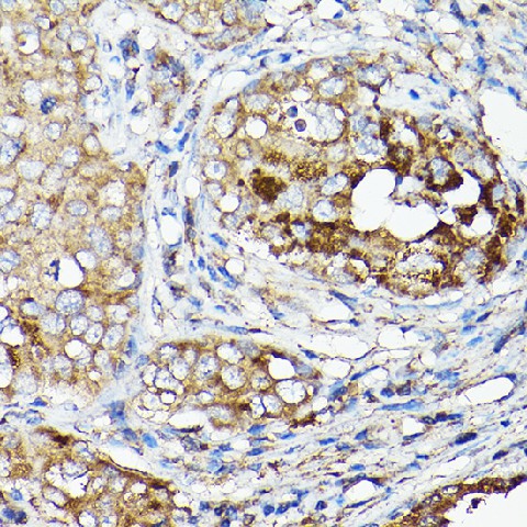 Immunohistochemistry of paraffin-embedded human breast cancer using LLGL1 Polyclonal Antibody at dilution of 1:50 (40x lens).Perform high pressure antigen retrieval with 10 mM citrate buffer pH 6.0 before commencing with IHC staining protocol.