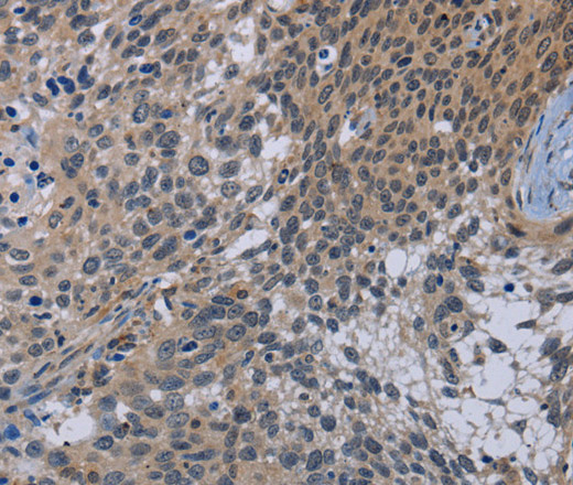 Immunohistochemistry of paraffin-embedded Human cervical cancer using CDC16 Polyclonal Antibody at dilution of 1:50