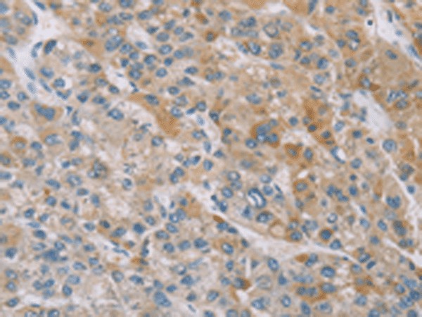 Immunohistochemistry of paraffin-embedded Human liver cancer tissue  using ZAK  Polyclonal Antibody at dilution of 1:100(?200)