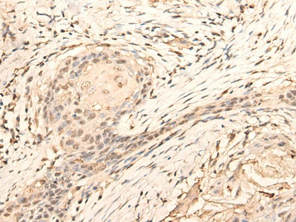 Immunohistochemistry of paraffin-embedded Human esophagus cancer tissue  using DAZ1 Polyclonal Antibody at dilution of 1:70(?200)