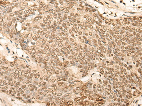 Immunohistochemistry of paraffin-embedded Human esophagus cancer tissue  using EIF4A3 Polyclonal Antibody at dilution of 1:45(?200)