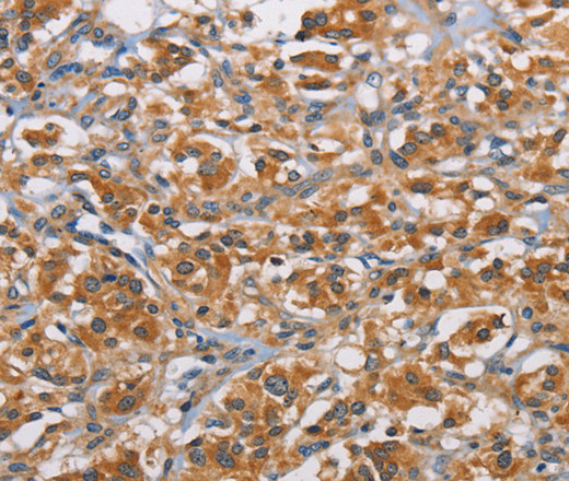 Immunohistochemistry of paraffin-embedded Human thyroid cancer tissue using RICTOR Polyclonal Antibody at dilution 1:40