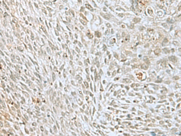 Immunohistochemistry of paraffin-embedded Human lung cancer tissue  using HOXC9 Polyclonal Antibody at dilution of 1:40(?200)