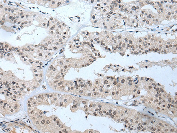 Immunohistochemistry of paraffin-embedded Human liver cancer tissue  using TBX1 Polyclonal Antibody at dilution of 1:40(?200)