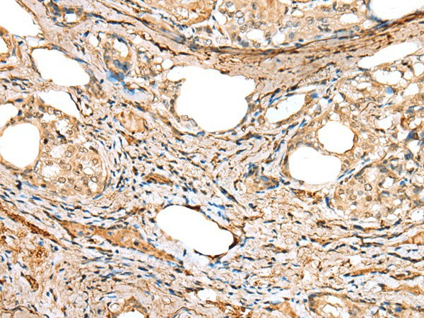 Immunohistochemistry of paraffin-embedded Human thyroid cancer tissue  using ATXN7L3 Polyclonal Antibody at dilution of 1:40(?200)