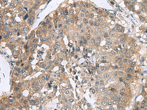 Immunohistochemistry of paraffin-embedded Human liver cancer tissue  using RPL18 Polyclonal Antibody at dilution of 1:70(?200)