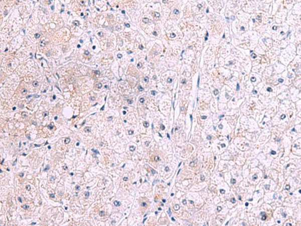 Immunohistochemistry of paraffin-embedded Human liver cancer tissue  using IRX2 Polyclonal Antibody at dilution of 1:45(?200)