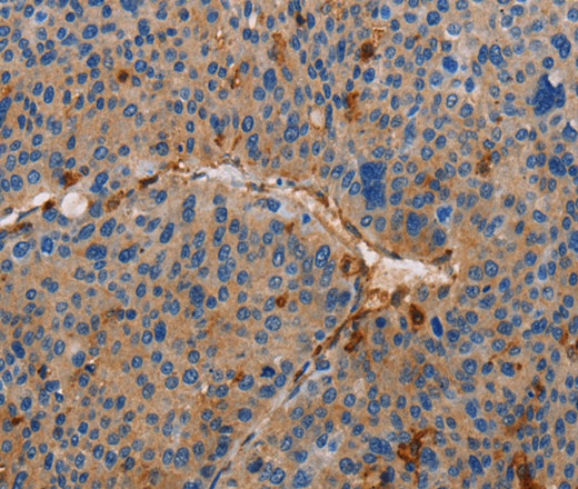 Immunohistochemistry of paraffin-embedded Human liver cancer tissue using AMBRA1 Polyclonal Antibody at dilution 1:50